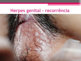 Herpes genital - recorrência

 