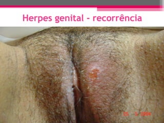 Herpes genital - recorrência

 