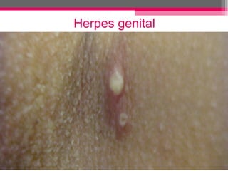 Herpes genital

 