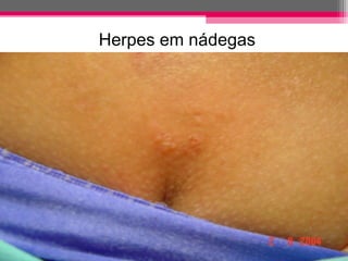 Herpes em nádegas

 