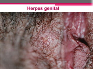Herpes genital

 