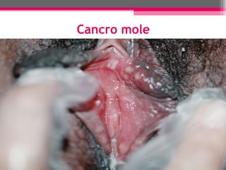Cancro mole

 