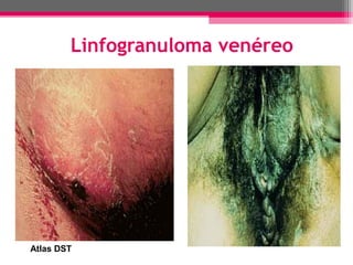 Linfogranuloma venéreo

Atlas DST

 