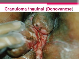 Granuloma inguinal (Donovanose)

 