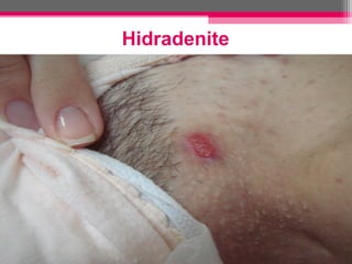 Hidradenite

 