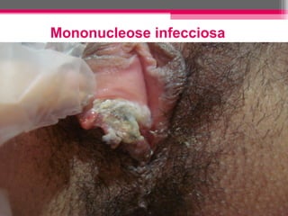 Mononucleose infecciosa

 