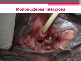 Mononucleose infecciosa

 