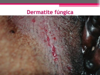 Dermatite fúngica

 