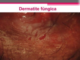 Dermatite fúngica

 