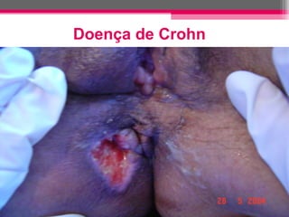 Doença de Crohn

 
