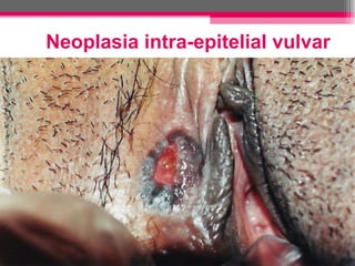 Neoplasia intra-epitelial vulvar

 