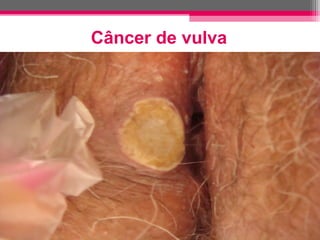 Câncer de vulva

 