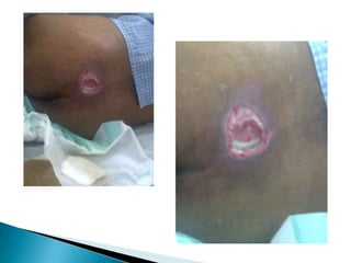 1. Desbridamiento El tejido húmedo y desvitalizado favorece la proliferación de organismos patógenos e interfiere el proceso de curación. El método de desbridamiento se elegirá dependiendo de la situación global del paciente y de las características del tejido a desbridar. Los diferentes métodos que se exponen, pueden combinarse para obtener mejores resultados.