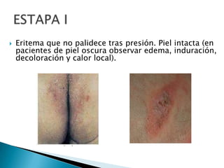 Eritema que no palidece tras presión. Piel intacta (en pacientes de piel oscura observar edema, induración, decoloración y calor local).     ESTAPA I