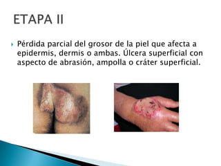 Pérdida parcial del grosor de la piel que afecta a epidermis, dermis o ambas. Úlcera superficial con aspecto de abrasión, ampolla o cráter superficial. ETAPA II