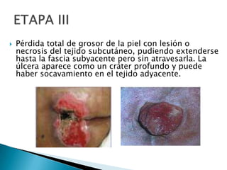 Pérdida total de grosor de la piel con lesión o necrosis del tejido subcutáneo, pudiendo extenderse hasta la fascia subyacente pero sin atravesarla. La úlcera aparece como un cráter profundo y puede haber socavamiento en el tejido adyacente. ETAPA III