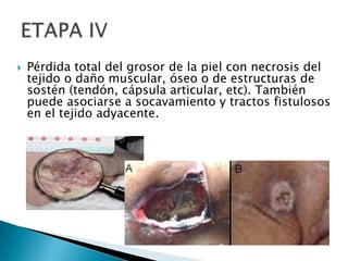 Pérdida total del grosor de la piel con necrosis del tejido o daño muscular, óseo o de estructuras de sostén (tendón, cápsula articular, etc). También puede asociarse a socavamiento y tractos fistulosos en el tejido adyacente.ETAPA IV