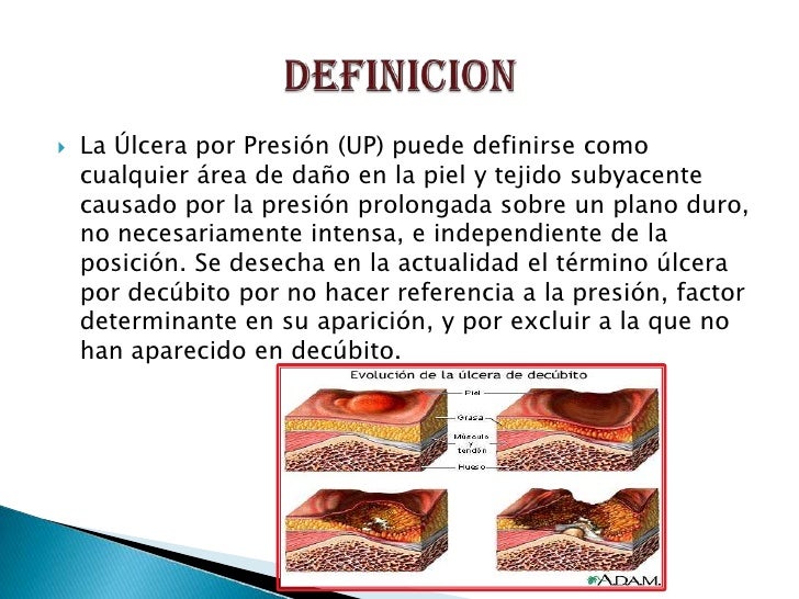 Ulceras por por presion Ulceras por por presion