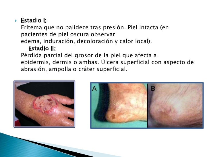 Que es hipertensión arterial causas y sintomas ?