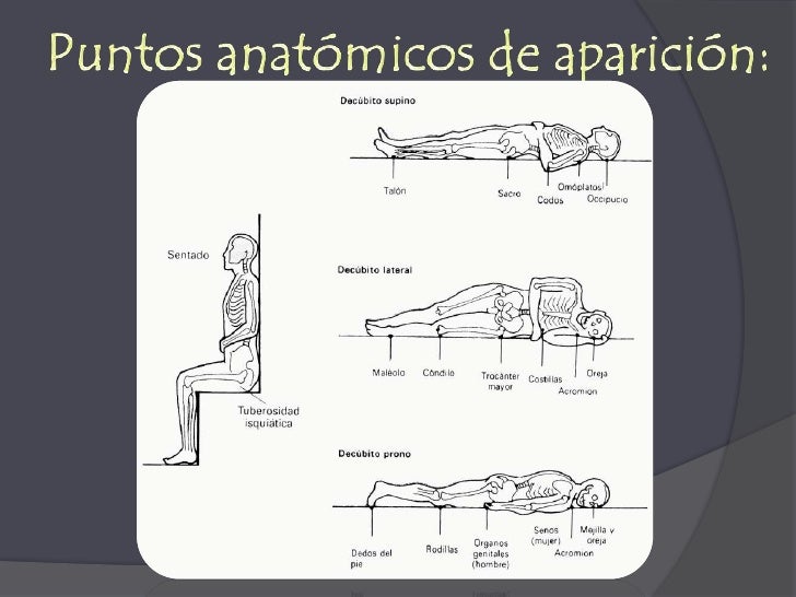 Varikoz el pinchazo la escleroobliteración