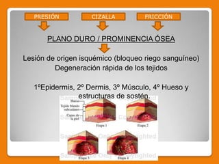 Ulceras por presion