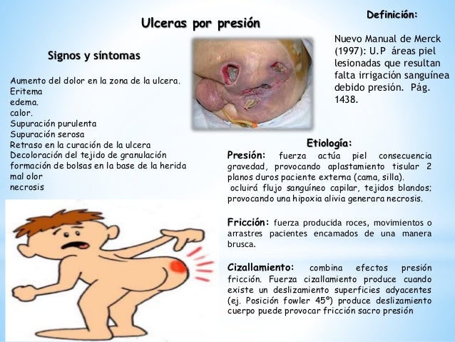Ulceras por presion