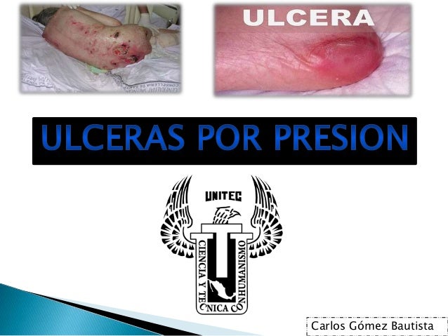 Ulceras por presion