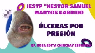 IESTP “NESTOR SAMUEL
MARTOS GARRIDO
ÚLCERAS POR
PRESIÓN
QF. ROSA EDITA CHINCHAY ESPINOZA
 