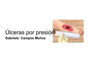 Úlceras por presión
Gabriela Campos Muñoz
 