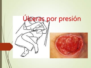 Úlceras por presión
 