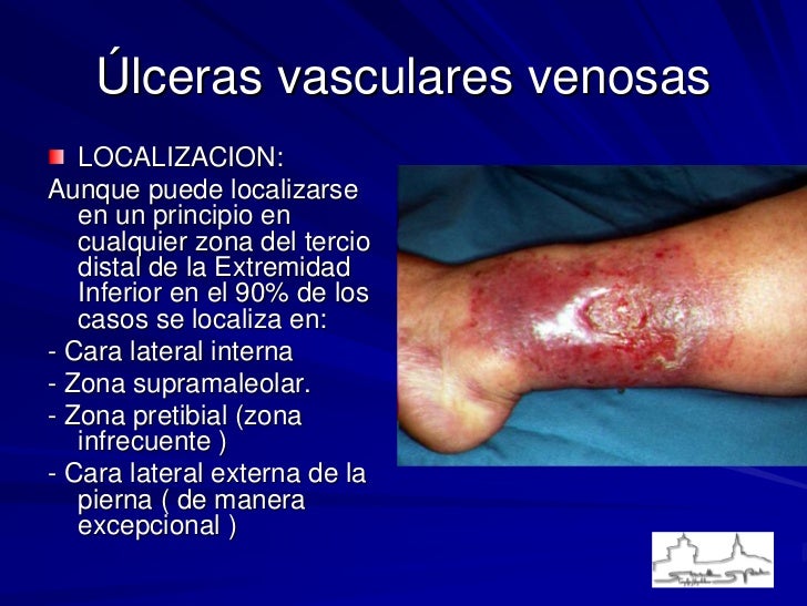 El tratamiento de los asteriscos vasculares por el vinagre de manzana
