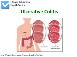Fitango Education
          Health Topics

                    Ulcerative Colitis




http://www.fitango.com/categories.php?id=104
 