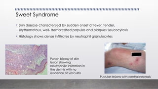 IBD related management ulcerative col.pptx