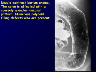 Ulcerative colitis | PPT