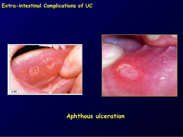 Purinethol For Colitis