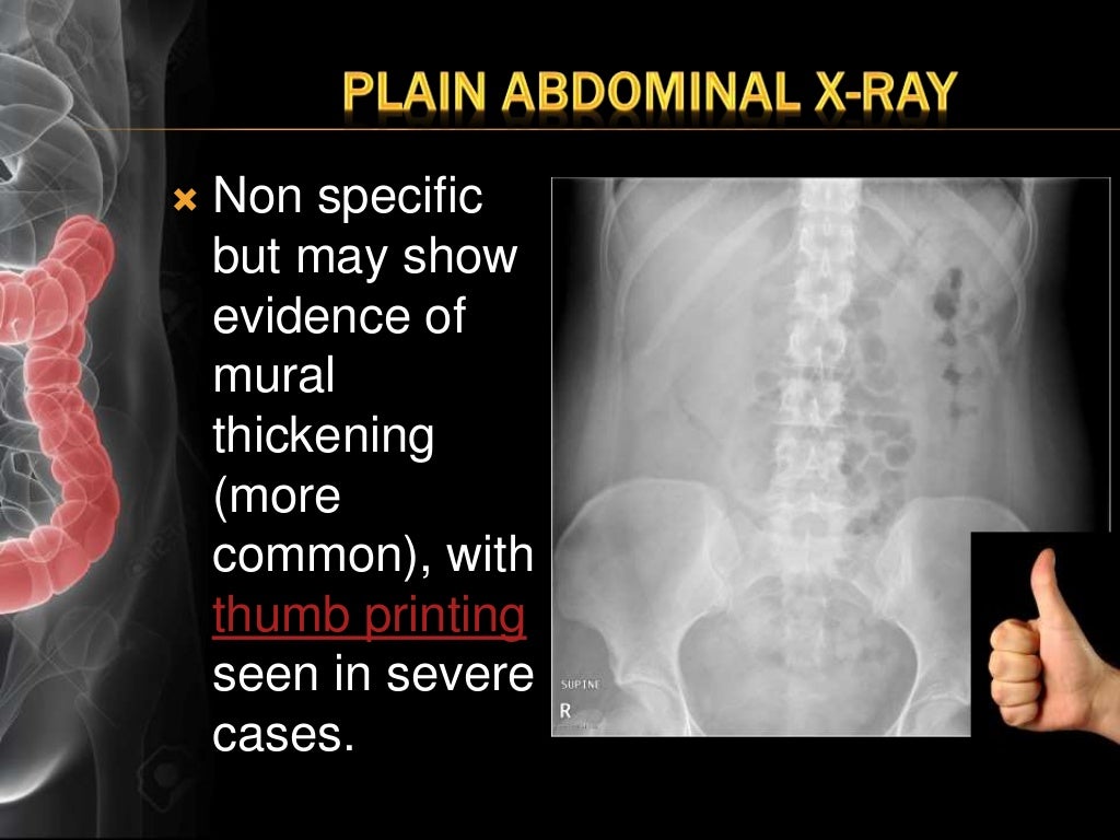 Ulcerative Colitis