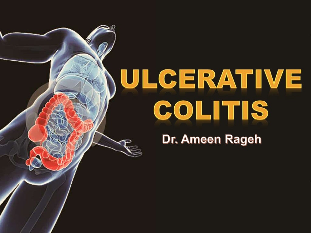 Ulcerative Colitis