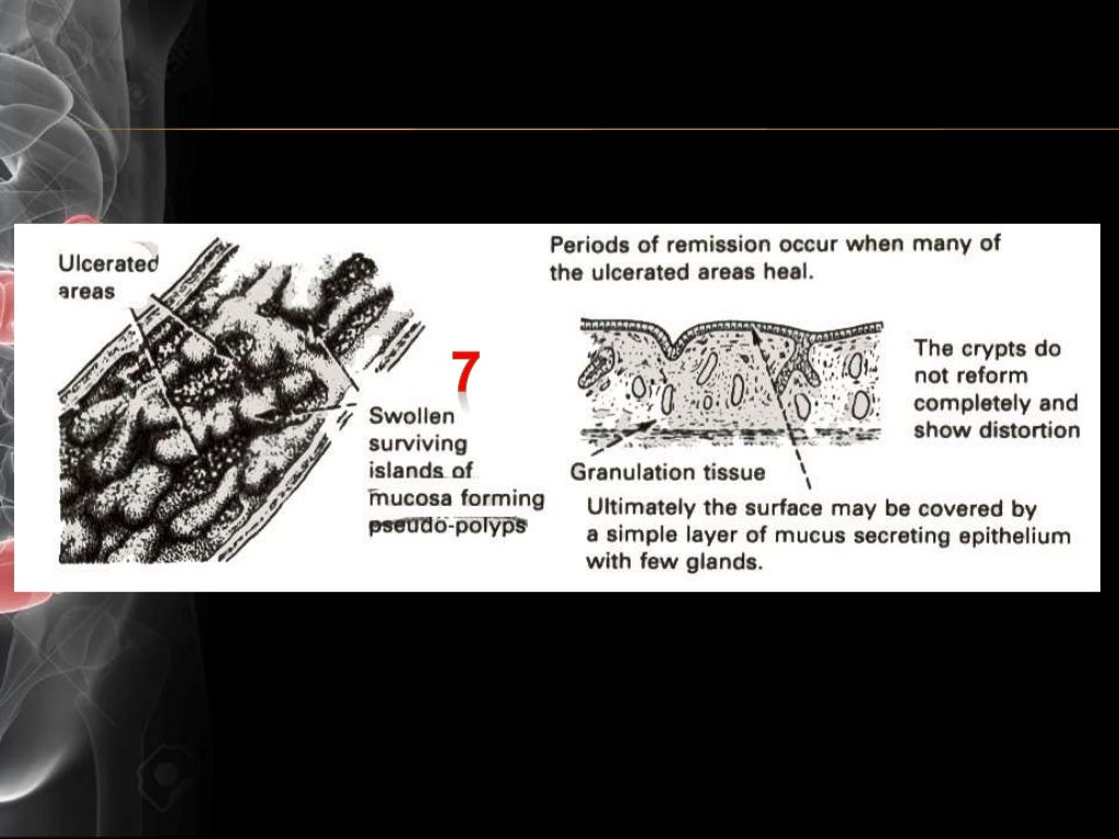 Ulcerative Colitis