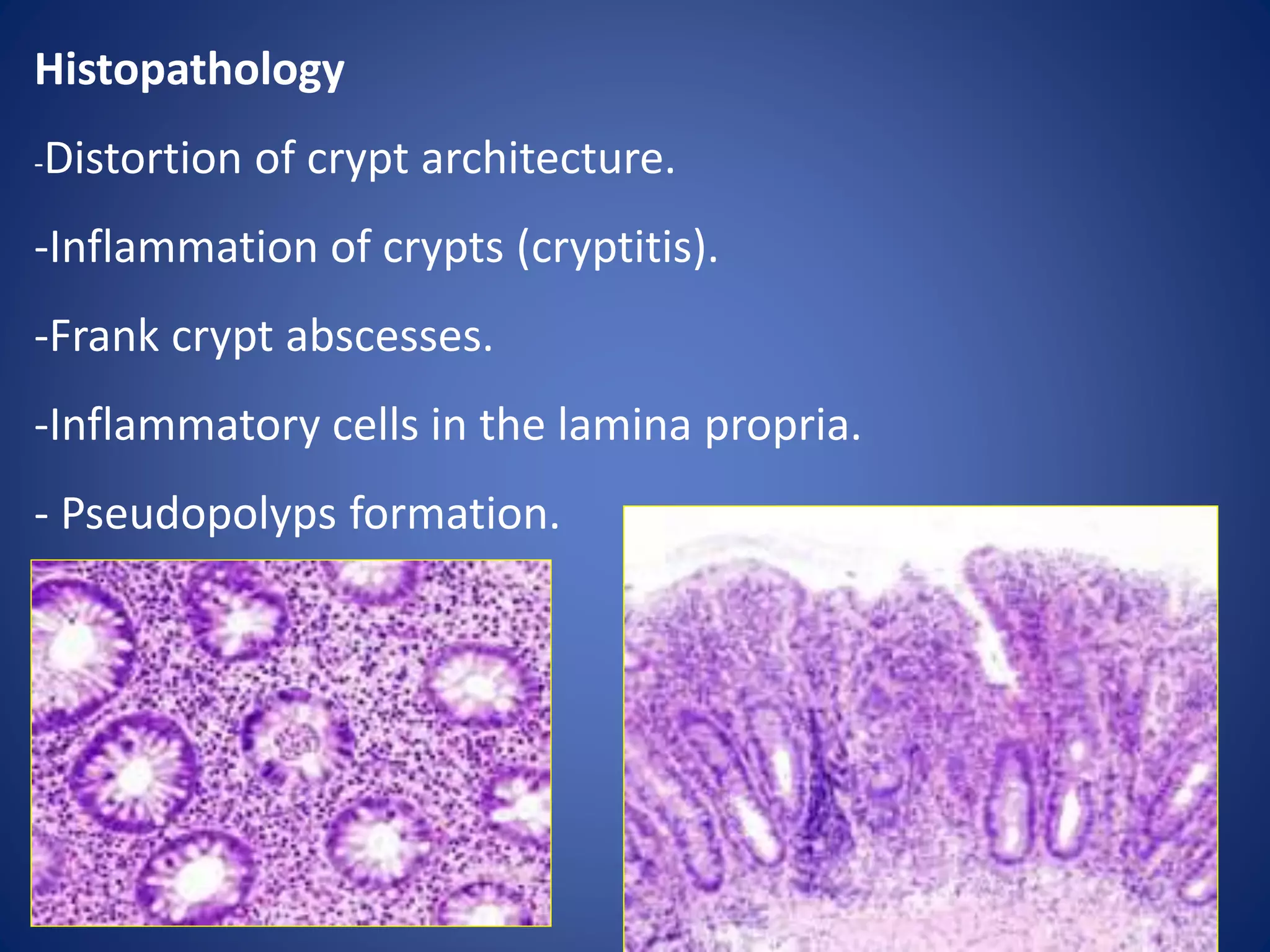 Ulcerative colitis | PPTX