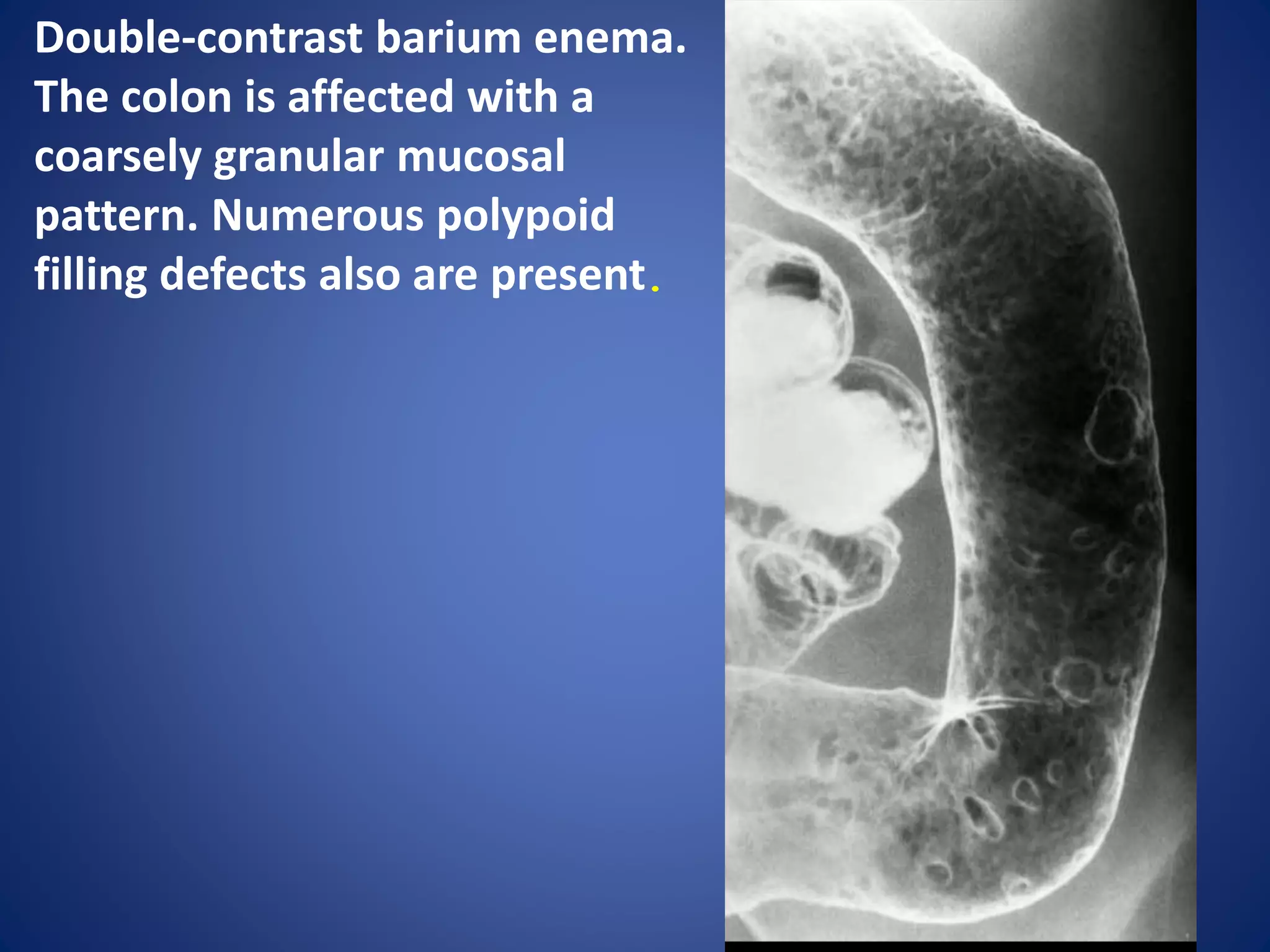 Ulcerative colitis | PPTX