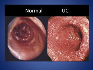 Uc Poop Ulcerative colitis | PPTX