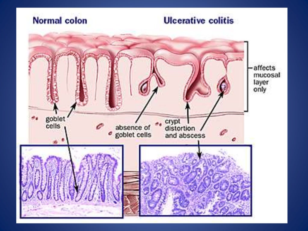 Ulcerative colitis