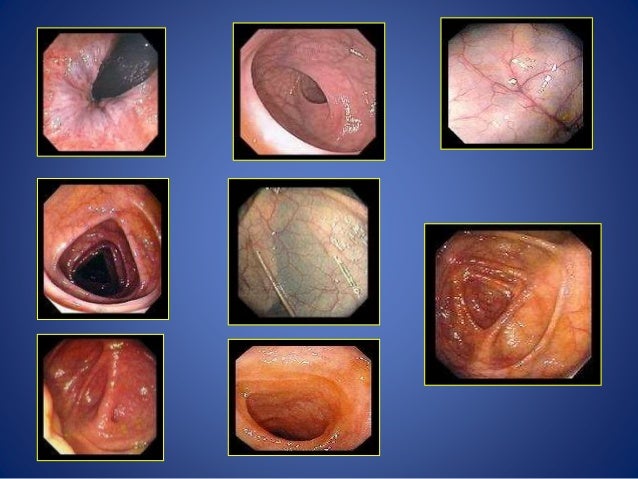 Purinethol For Colitis