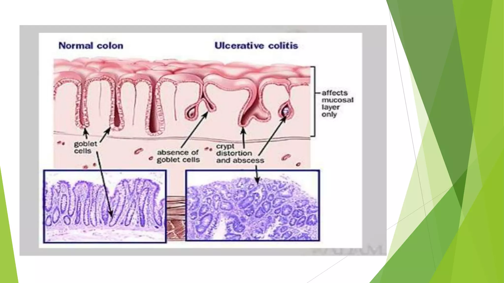 Ulcerative colitis | PPTX