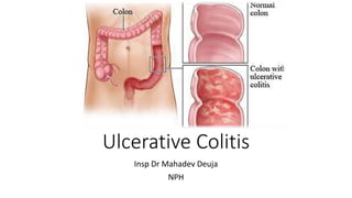 Ulcerative Colitis
Insp Dr Mahadev Deuja
NPH
 