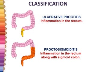 ULCERATIVE COLITIS | PPTX