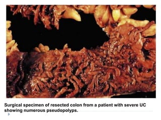 Surgical specimen of resected colon from a patient with severe UC
showing numerous pseudopolyps.
 