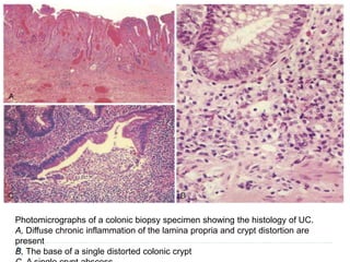 Photomicrographs of a colonic biopsy specimen showing the histology of UC.
A, Diffuse chronic inflammation of the lamina propria and crypt distortion are
present
B, The base of a single distorted colonic crypt
 