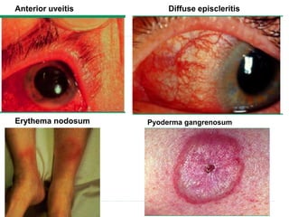 Diffuse episcleritisAnterior uveitis
Erythema nodosum Pyoderma gangrenosum
 