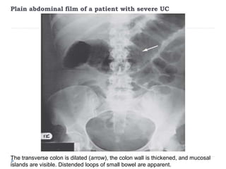 Plain abdominal film of a patient with severe UC
The transverse colon is dilated (arrow), the colon wall is thickened, and mucosal
islands are visible. Distended loops of small bowel are apparent.
 